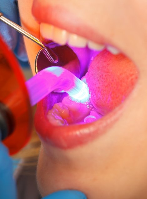 Close up of a dental patient receiving cosmetic dental bonding