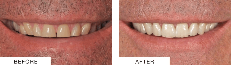 Close up of a smile before and after dental treatment in Buckhead Atlanta