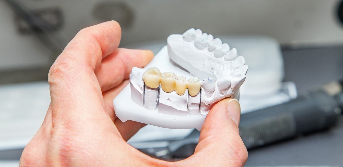 Hand holding cast of lower arch containing dental bridge