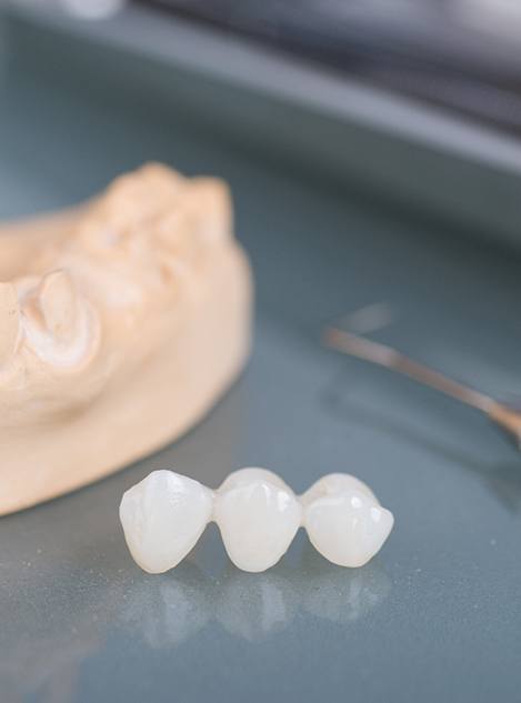 Dental bridge next to cast of lower arch and dental instrument on reflective surface