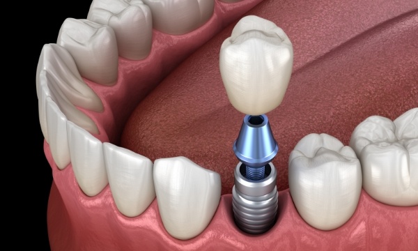 Animated dental implant with dental crown replacing one missing tooth