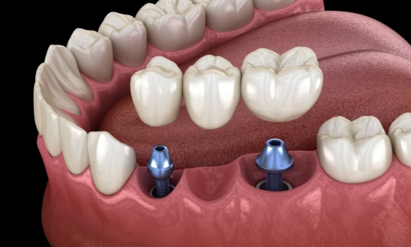 Two animated dental implants supporting a dental bridge