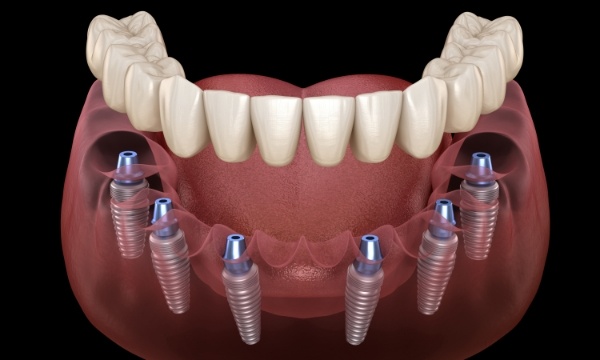 Six animated dental implants supporting an implant denture