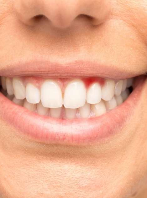Close up of a person with red gums smiling