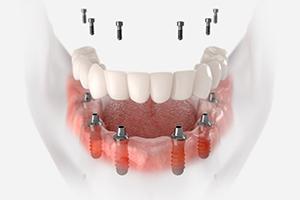 Illustration of fixed implant denture against white background