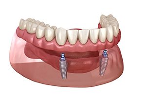 Illustration of removable implant denture for lower arch