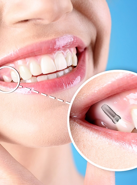 A closeup of a woman with a fully-placed dental implant