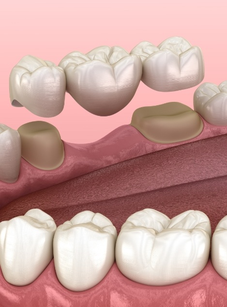 Animated dental bridge replacing a missing tooth