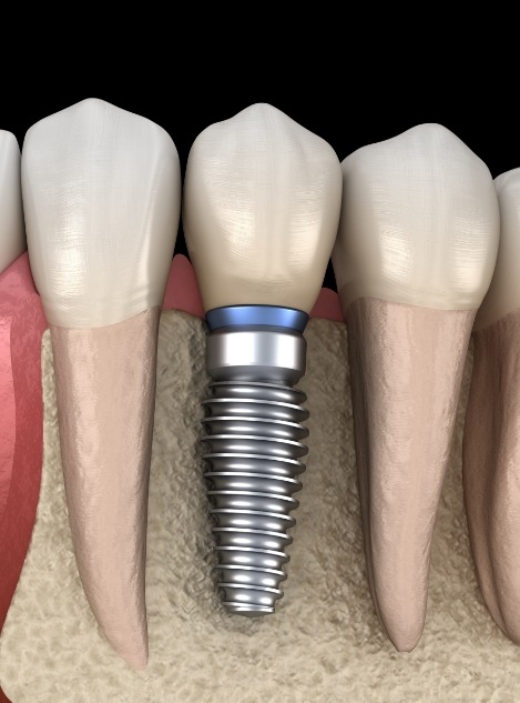 Animated dental implant in the lower jaw