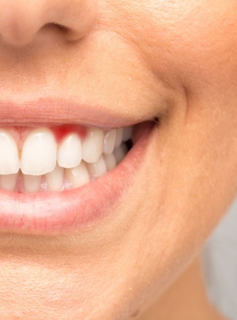 Close up of a person smiling with some redness in their gums