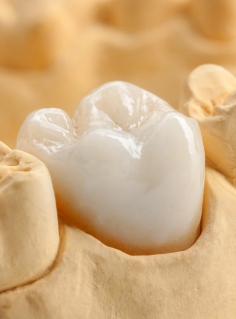 Porcelain dental crown in a model of a row of teeth