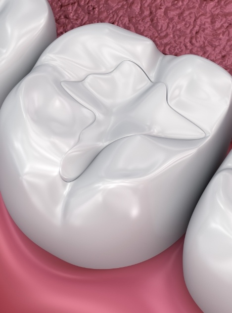 Animated tooth with a tooth colored filling