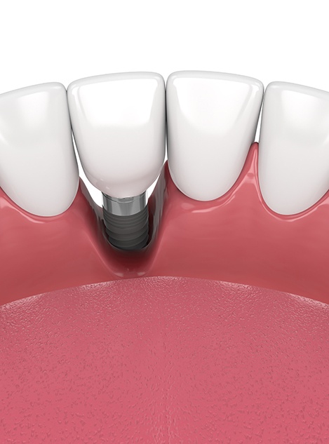 Illustration of bone loss around failed dental implant in Buckhead