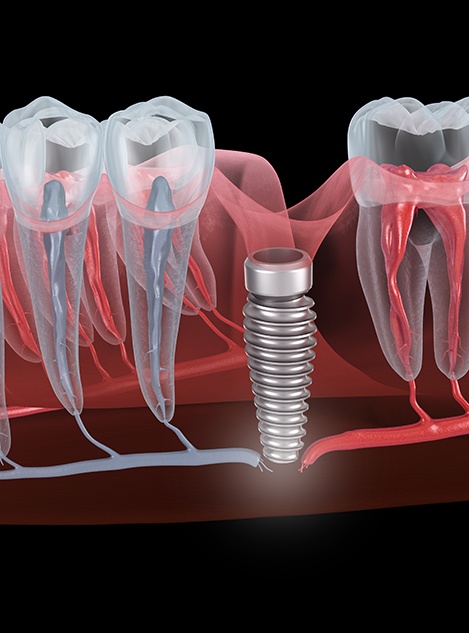 Illustration of a failed dental implant in the lower arch