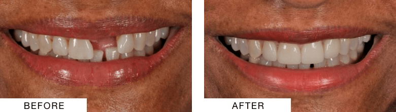 Close up of a smile before and after seeing Atlanta dentist