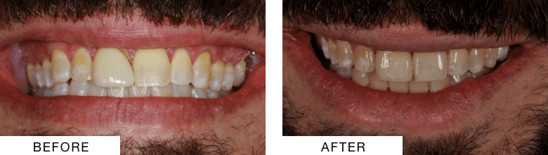 Close up of a smile before and after cosmetic dental treatment