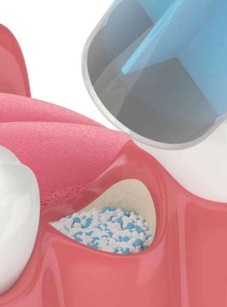 Animated dental bone grafting material being added to site of tooth extraction in Atlanta