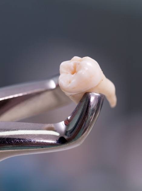 Extracted tooth being held in pair of dental forceps