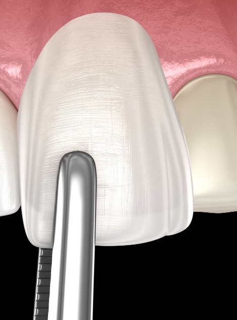 Animated veneer being placed over a tooth