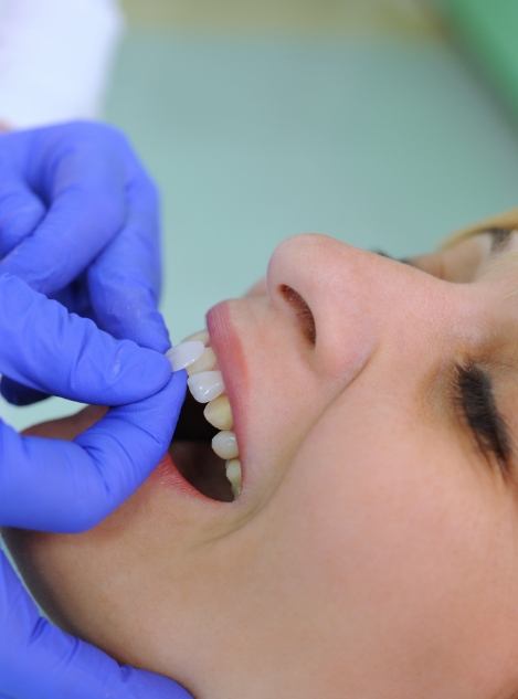 Dentist placing a veneer over a patient's upper front tooth