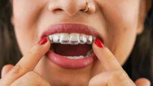 a woman putting clear aligners in her mouth